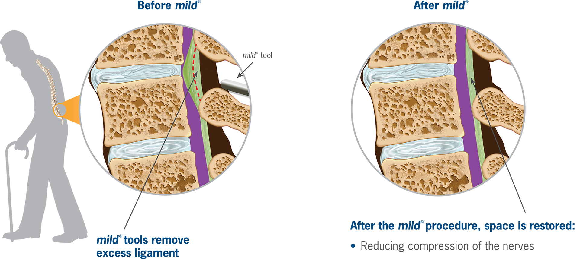 LSS Treatment with Mild Procedure